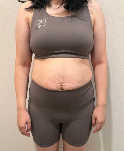 diastasis recti looks like img 2