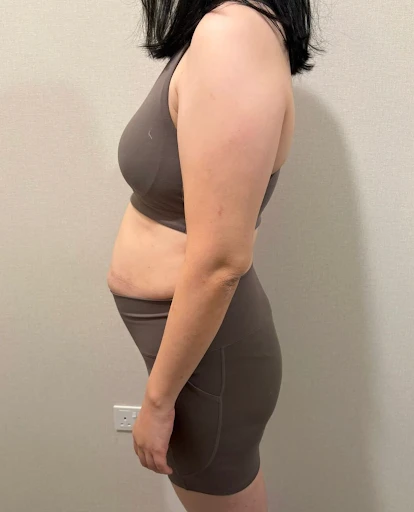 diastasis recti looks like img 3