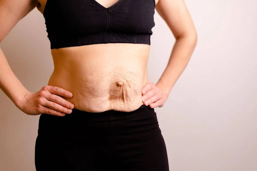 diastasis recti looks like img