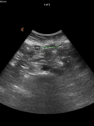 After Ultrasound