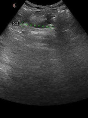 Before Ultrasound
